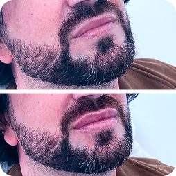 Lip Volume Restoration