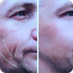 Nasolabial Smoothing